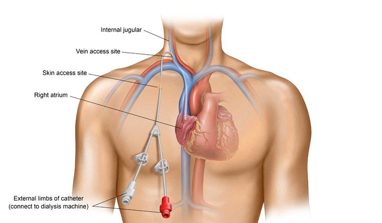 Central Venous uncuffed Hemodialysis catheters