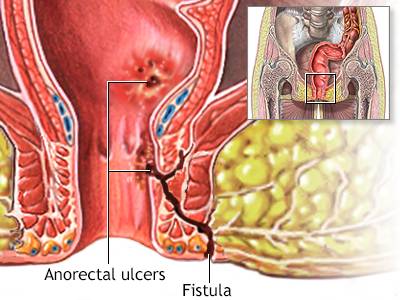 Fistulograms