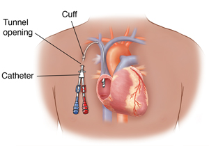 Tunnelled Cuffed Catheters