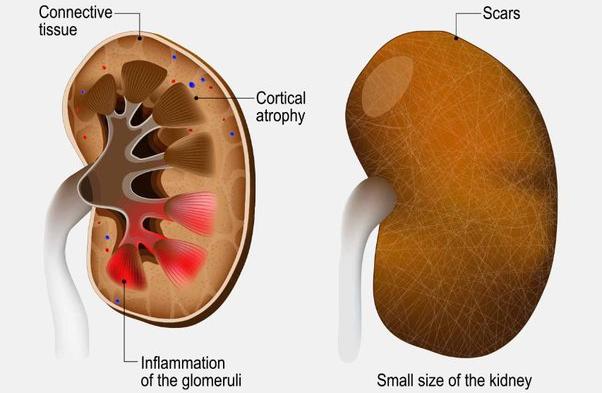 Glomerular Diseases